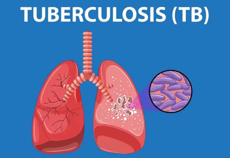 India’s Battle Against Tuberculosis – Daily Excelsior